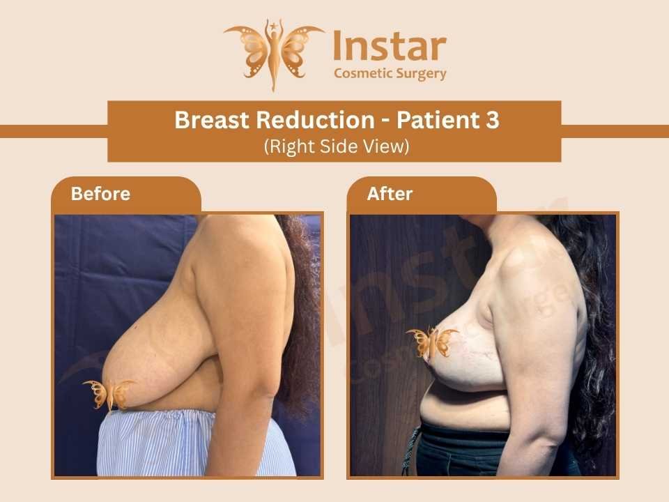 Breast Reduction (Right Side View)